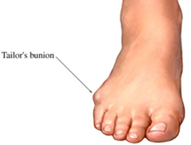 Tailor's Bunion