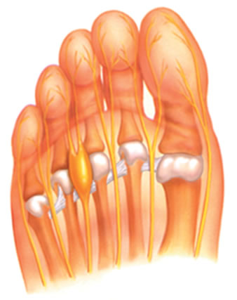Neuroma