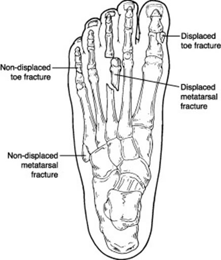 Toe Fracture